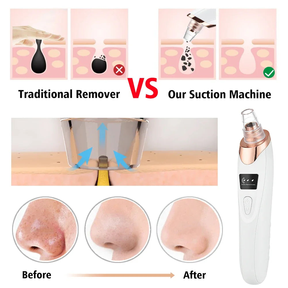 Electric Blackhead Remover Vacuum – 5 Suction Heads & 3 Power Levels