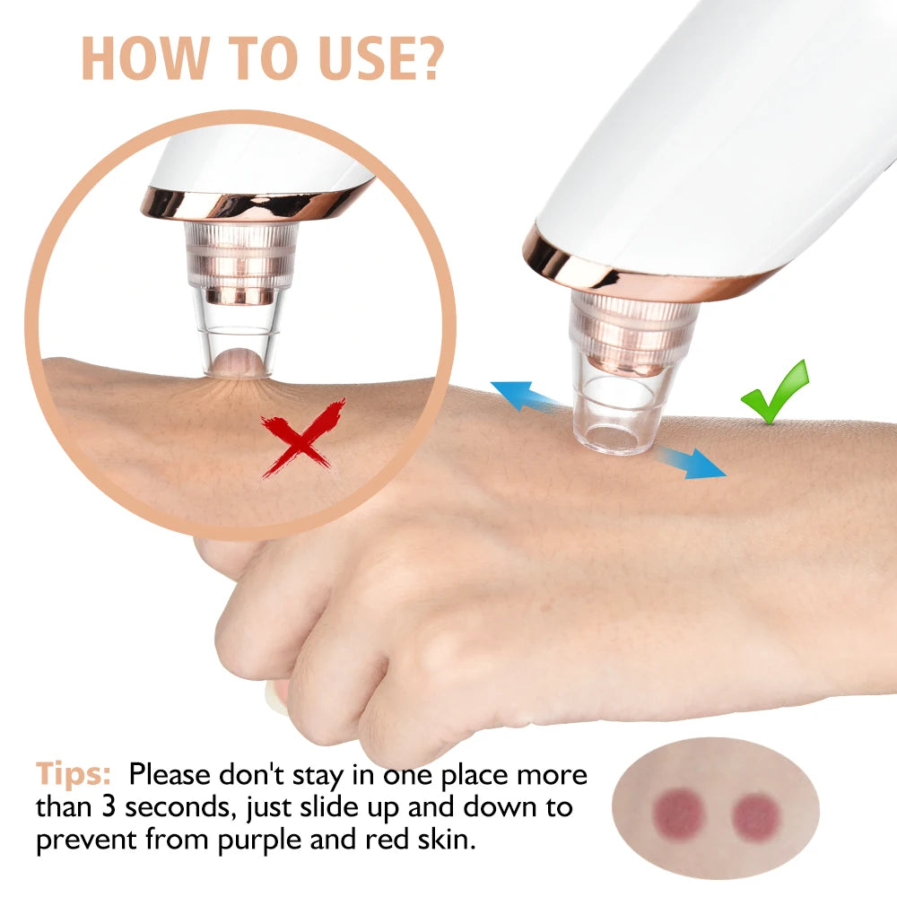 Electric Blackhead Remover Vacuum – 5 Suction Heads & 3 Power Levels