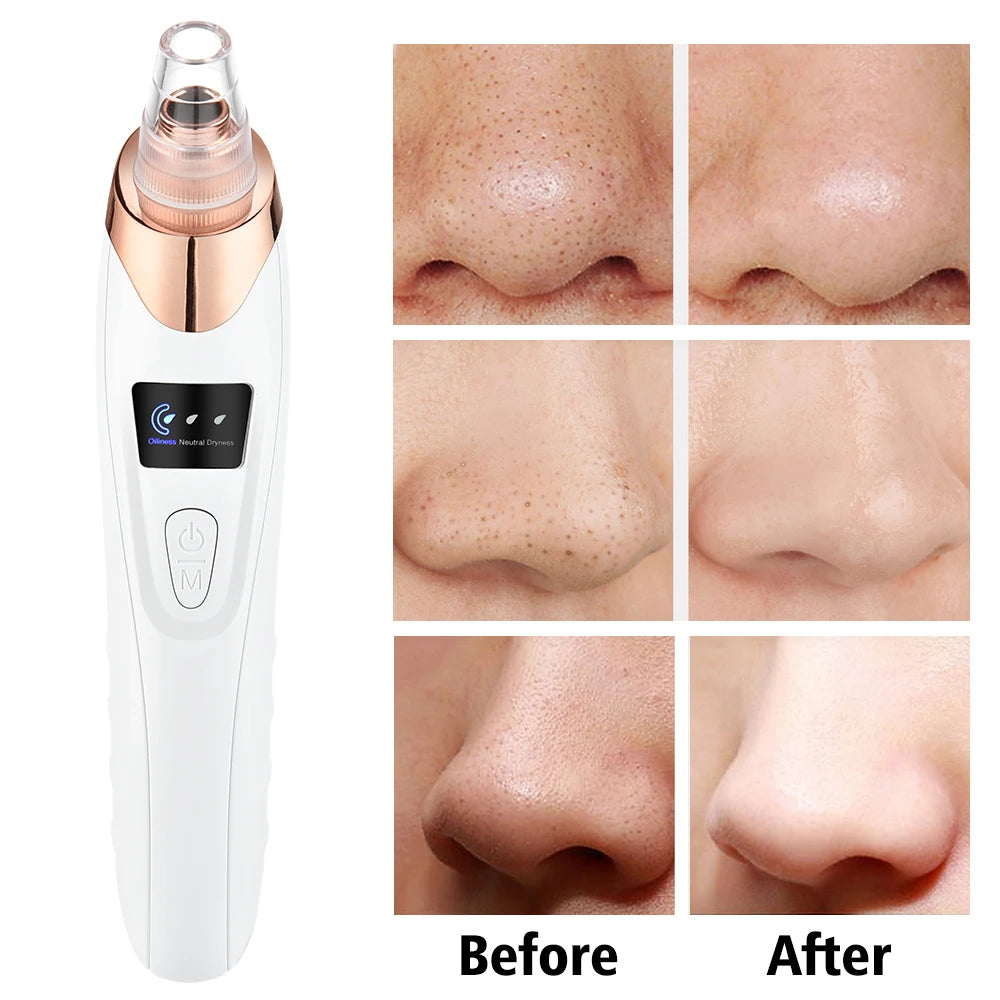 Electric Blackhead Remover Vacuum – 5 Suction Heads & 3 Power Levels