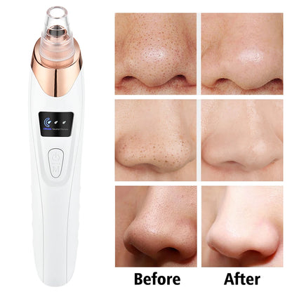 Electric Blackhead Remover Vacuum – 5 Suction Heads & 3 Power Levels